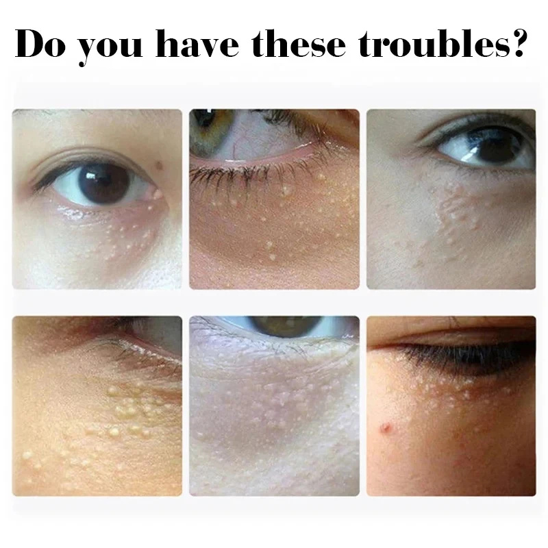 Fat Granules Remover Eye Cream - đánh giá và giá Coenzyme Q10 Cream