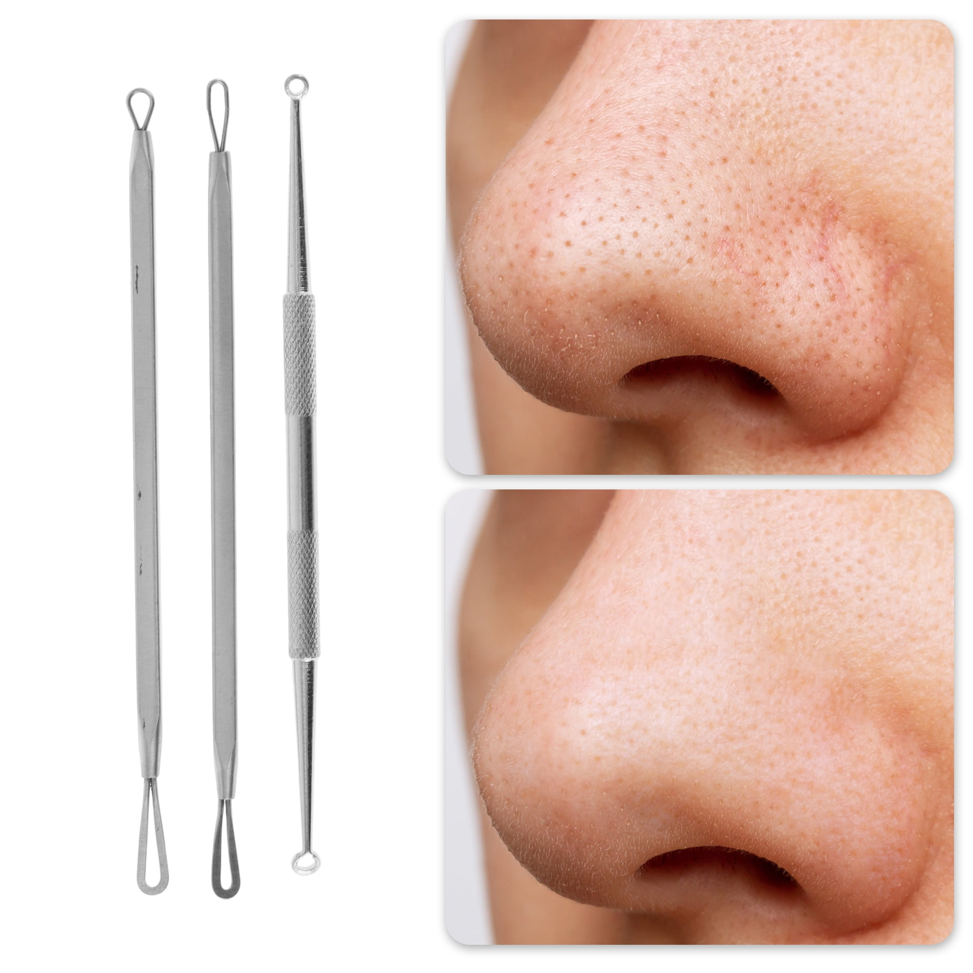 Professional Pimple Extractor  - đánh giá và giá Skincare Whitening